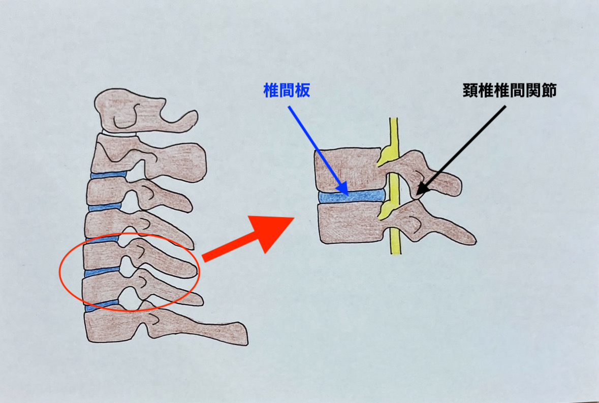 頚椎椎間関節症画像1